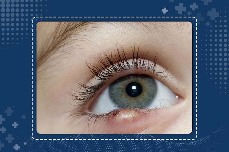 What is stye eye?